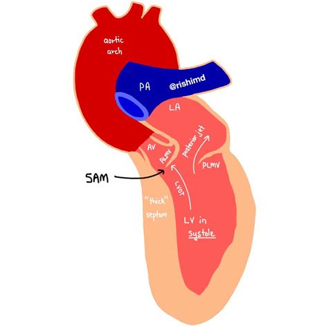 Left Ventricular Outflow Tract Obstruction 